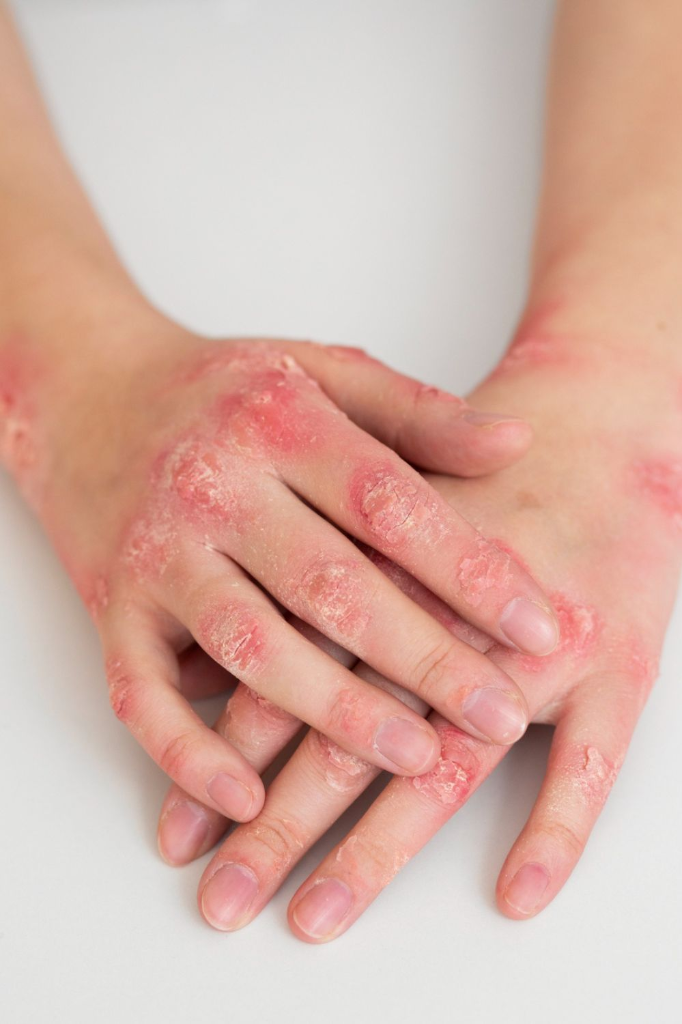 Eczema Management