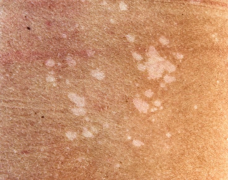 Fungal Infections Care