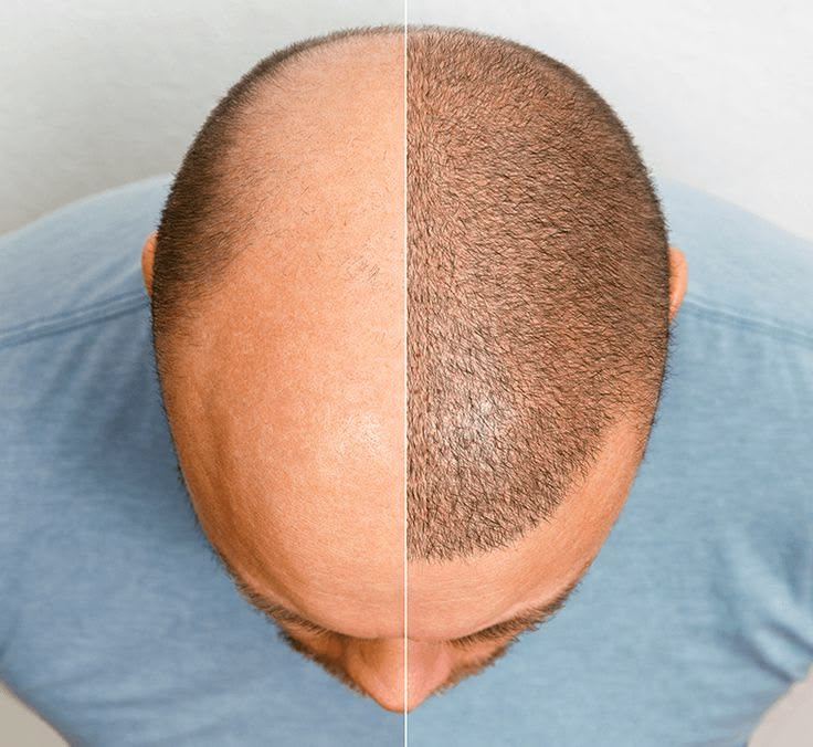 Hair Transplant FUE
