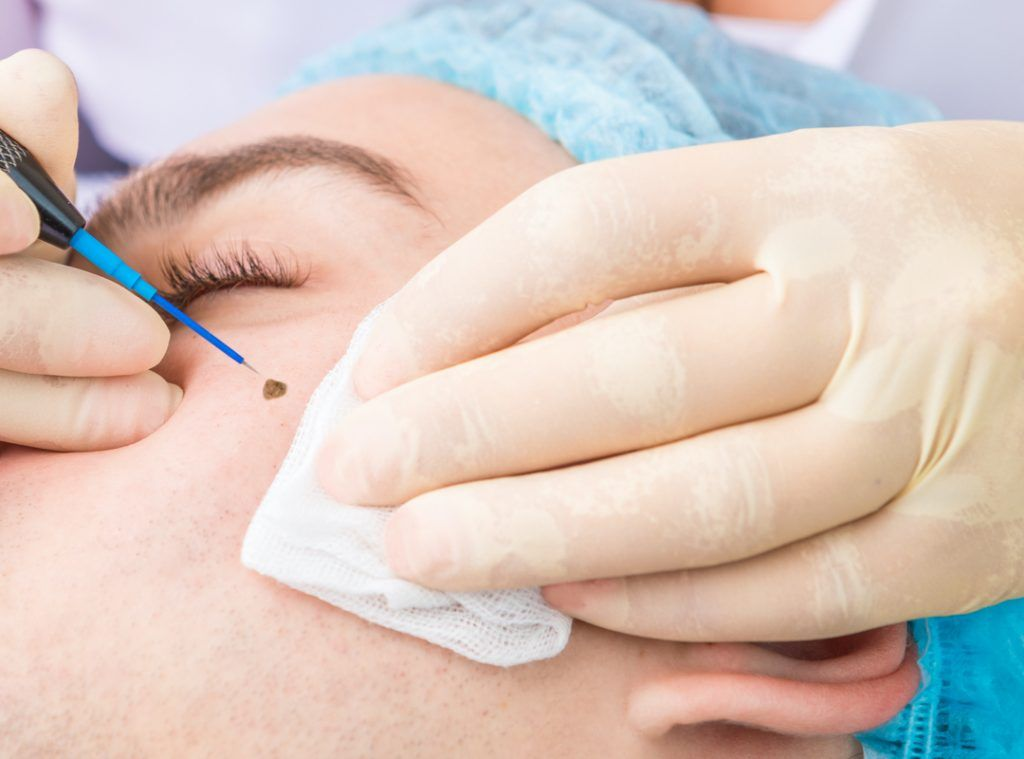 Moles and Warts Treatment