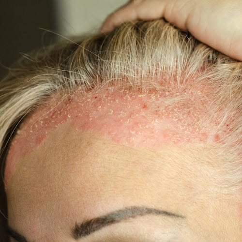 Psoriasis Care