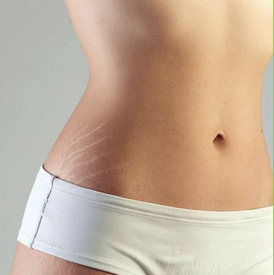 Stretch Marks Clinical Care